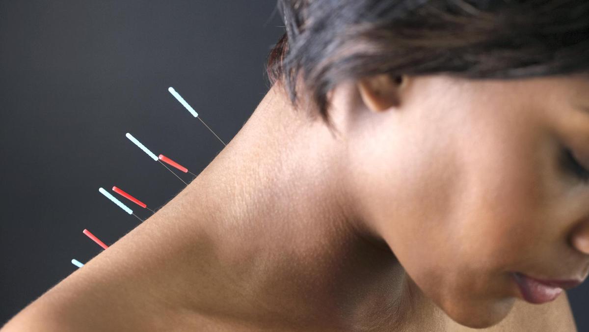 Acupuncture for Chronic Pain: What You Need to Know