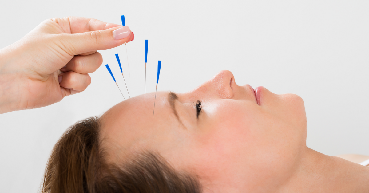 Acupuncture for anxiety relief