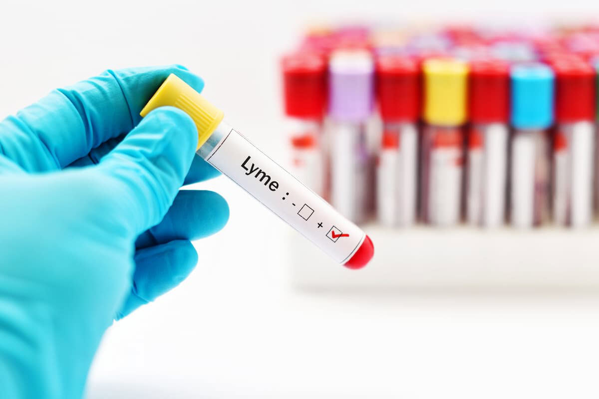 Lyme disease testing