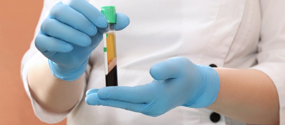 Blood plasma in hands for PRP therapy