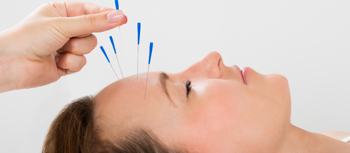 Acupuncture treatment in Calgary